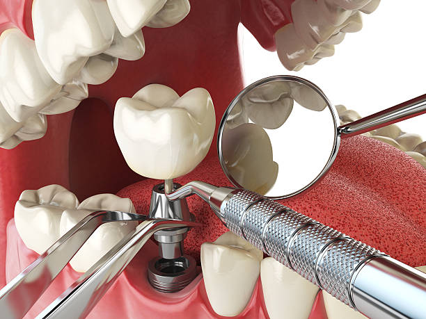 Best Emergency Treatment for Dental Infections or Abscesses in Jonesboro, GA